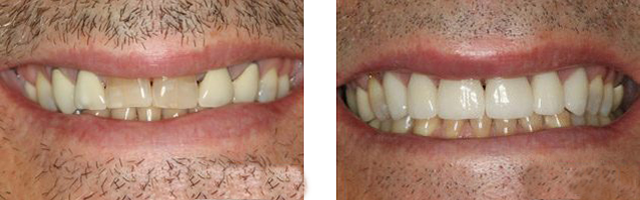 veneer example