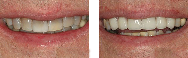 veneer example